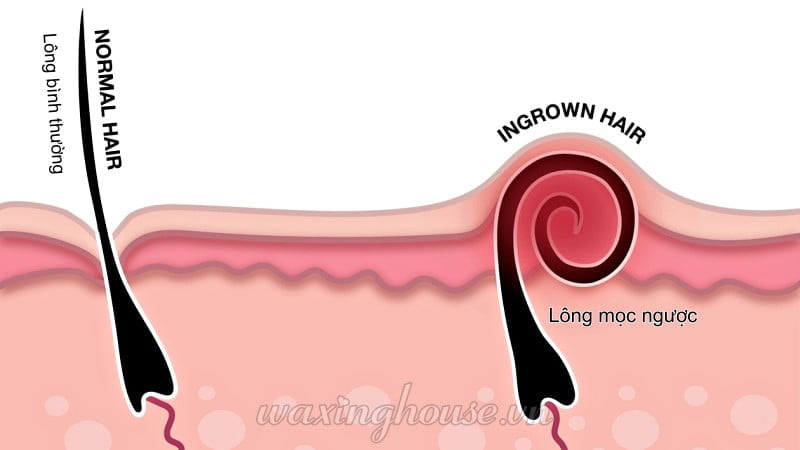 Ingrown hair causes and how to treat Waxing House