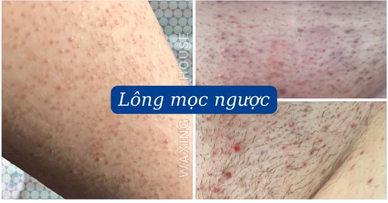 Cách trị lông mọc ngược