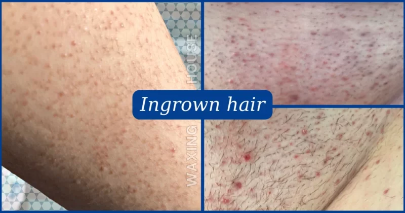 How to treat ingrown hair?